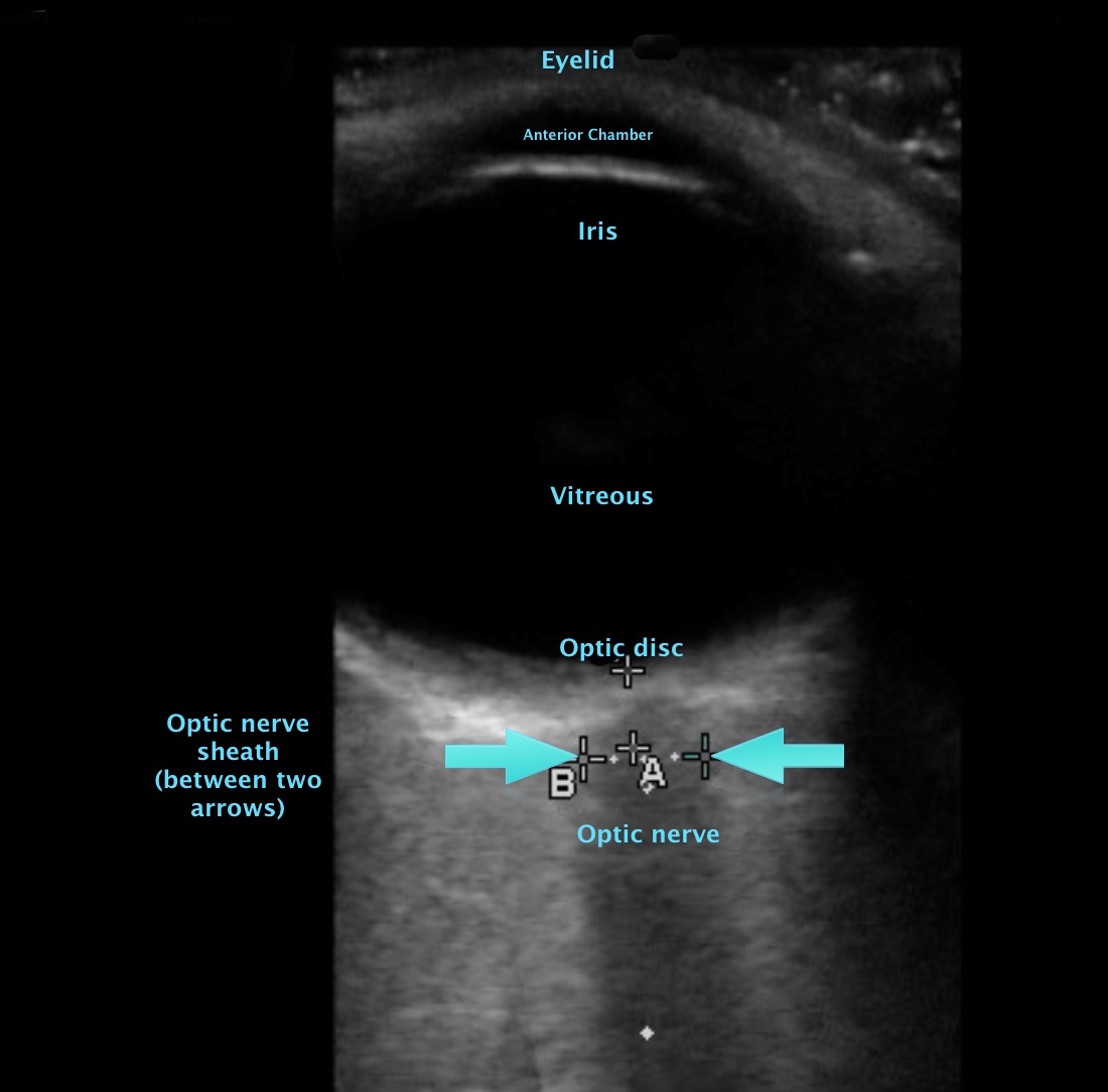 Optic Nerve Sheath Diameter