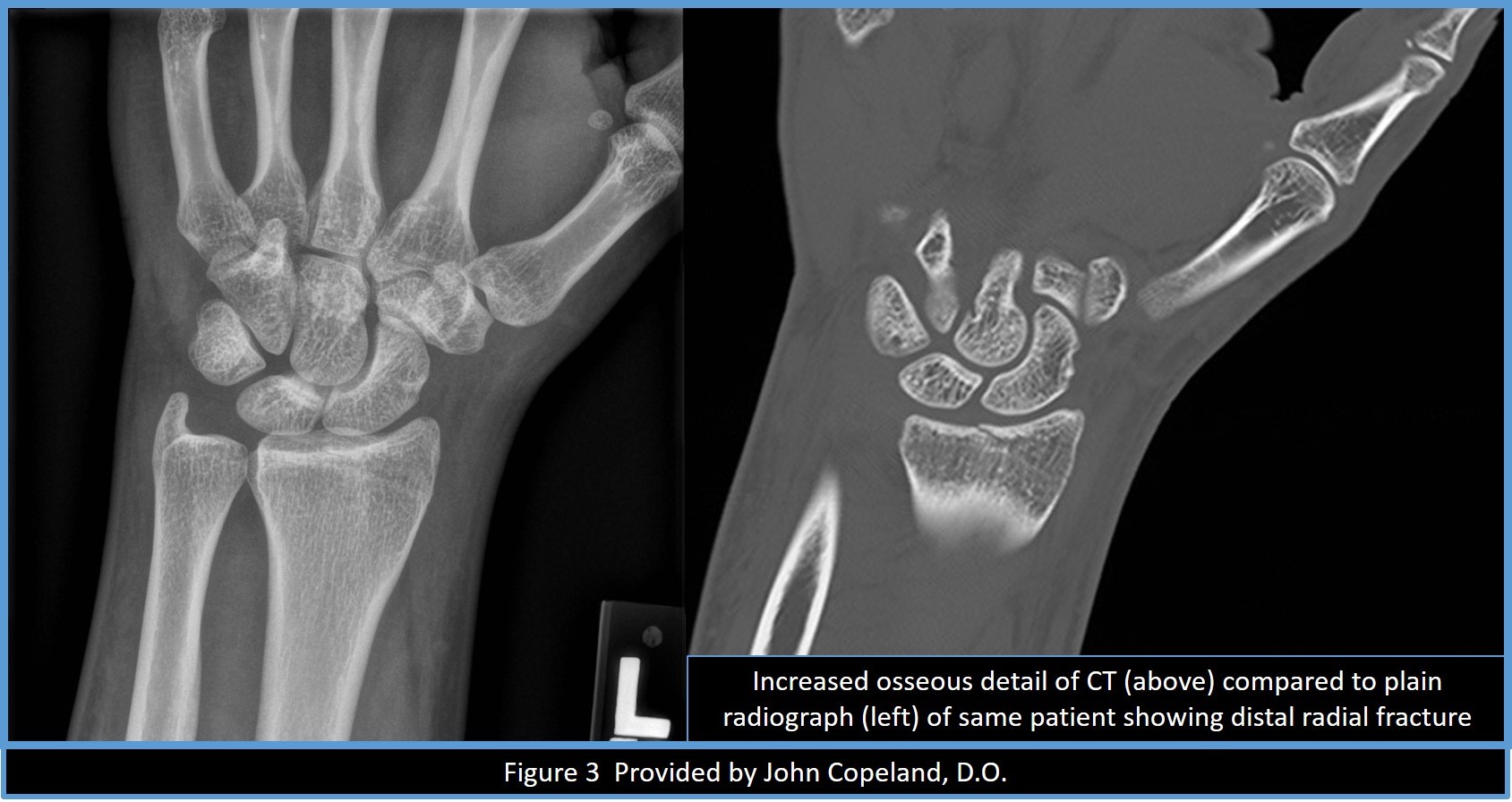 Wrist Fracture | Treatment & Management | Point of Care