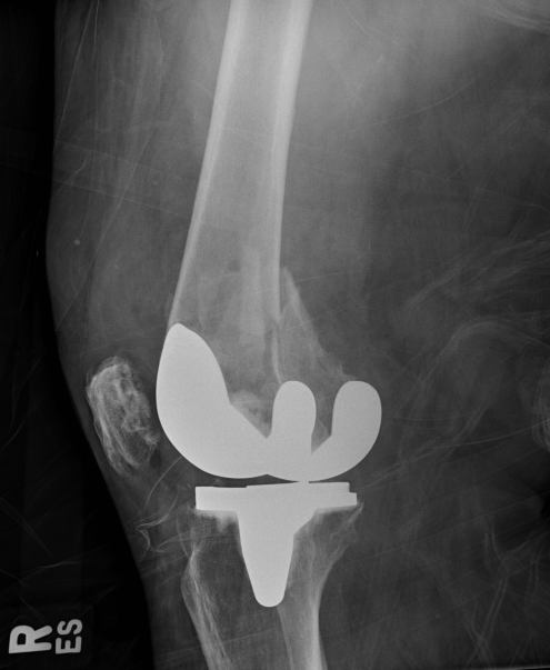 Periprosthetic Distal Femur Fracture Article