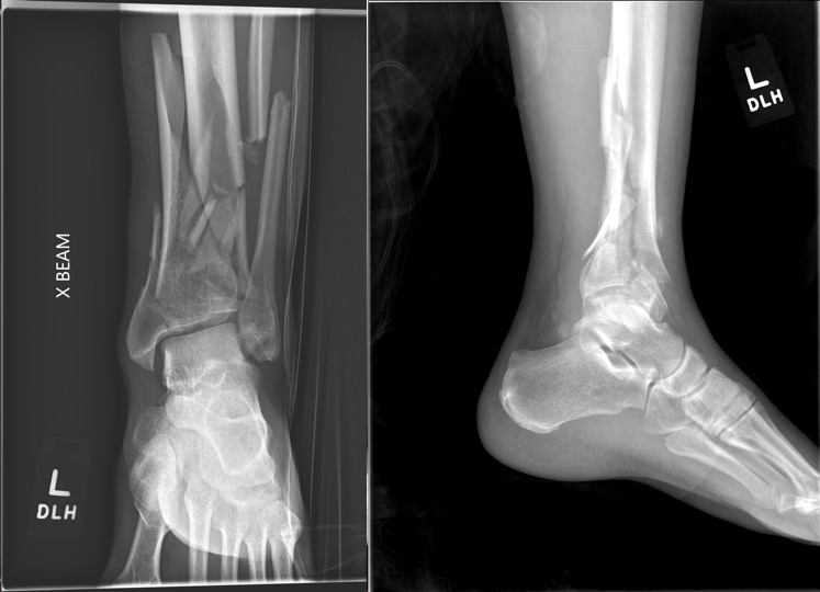 Pilon Fracture Article