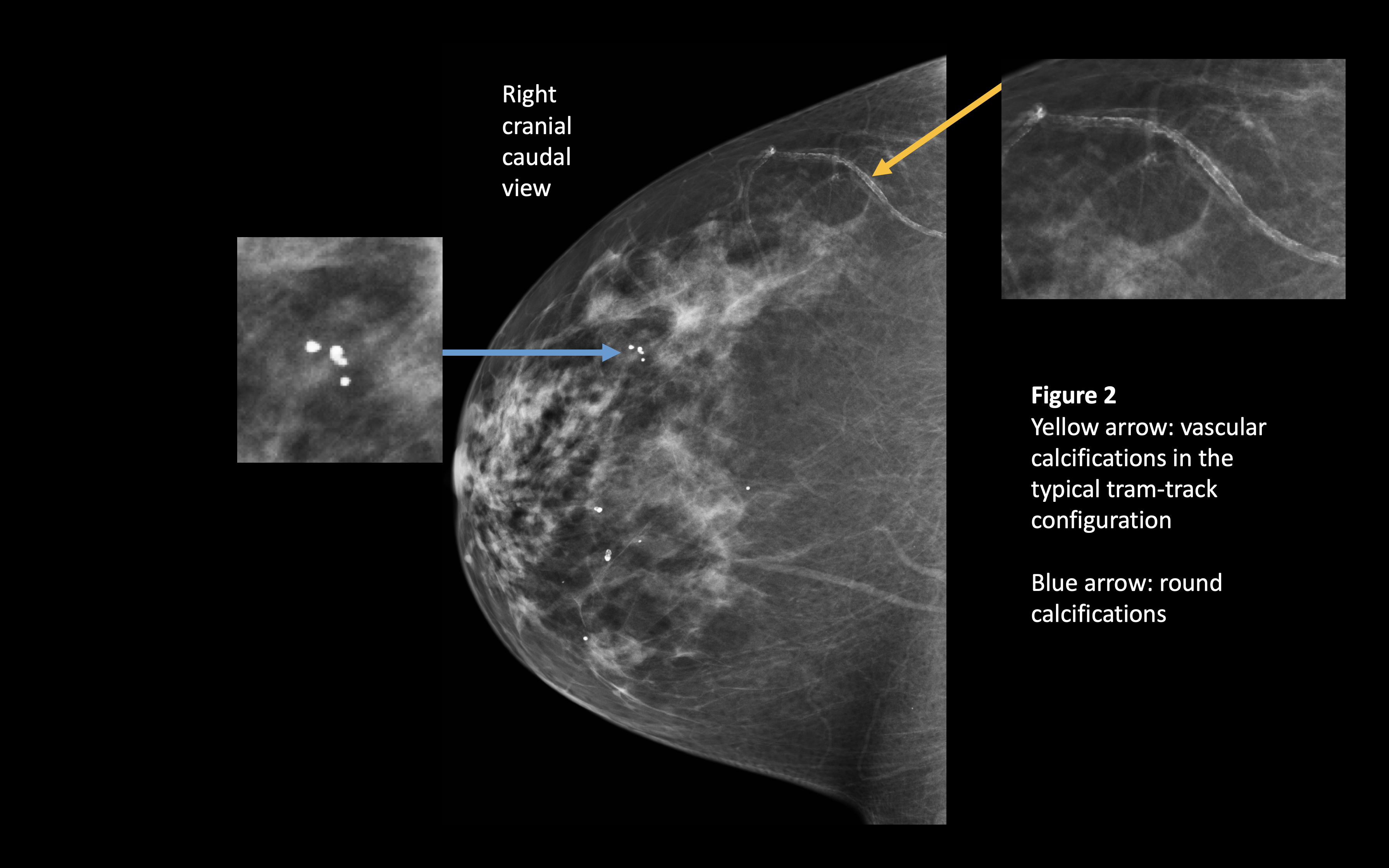 Benign Breast Calcifications Article