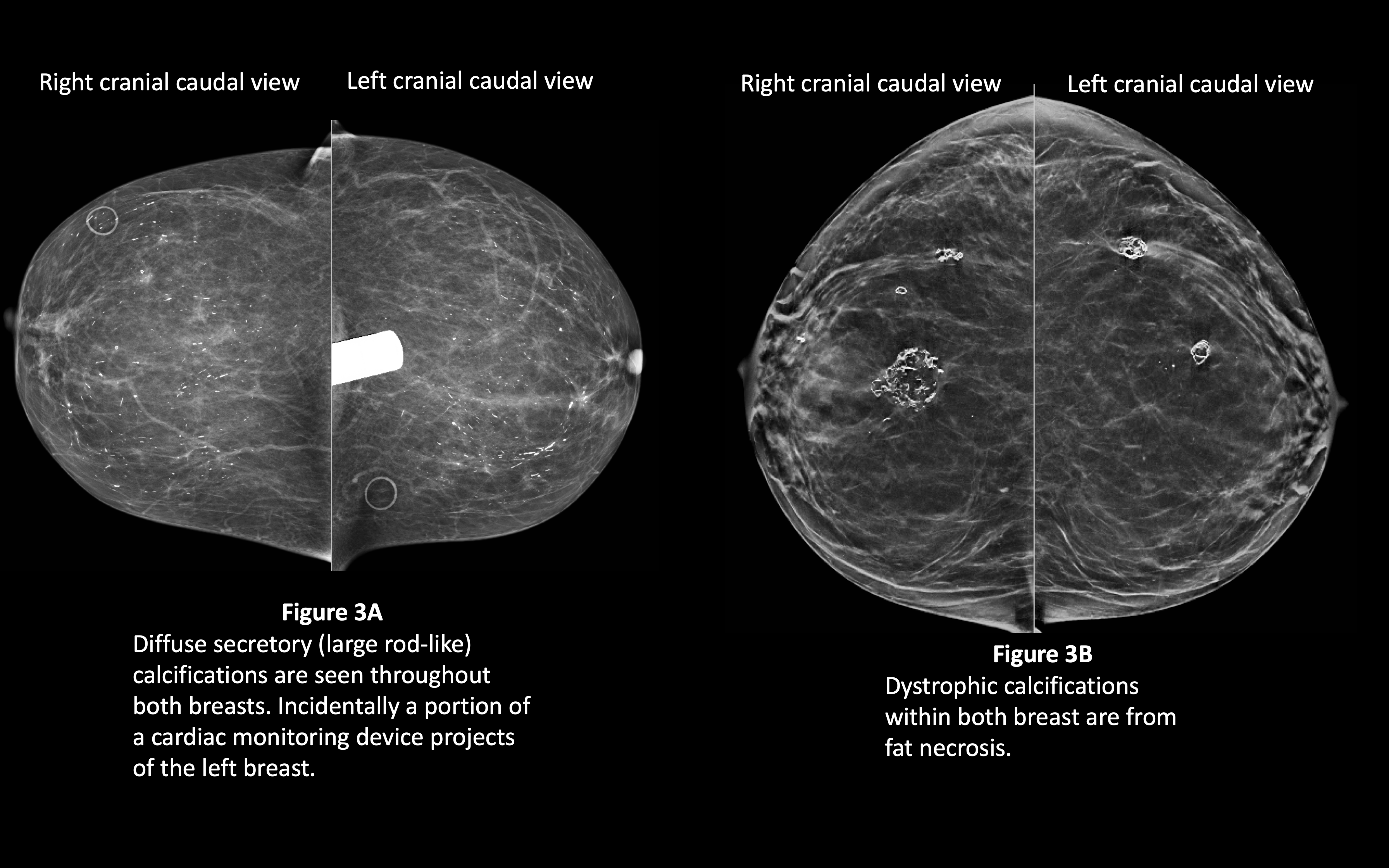 Жировой некроз молочной железы. Книги breast Cancer табар castings Types calcification.