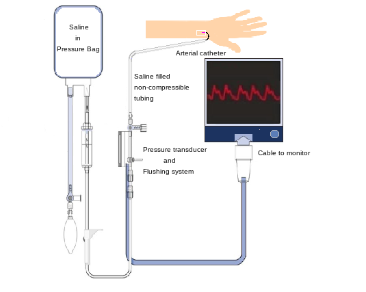 Arterial Pressure Monitoring Article