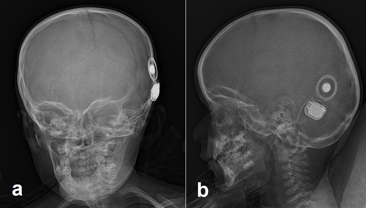 Cochlear Implants Article