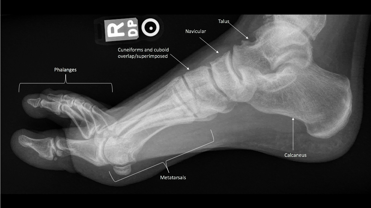 Anatomy, Bony Pelvis and Lower Limb, Foot Bones Article