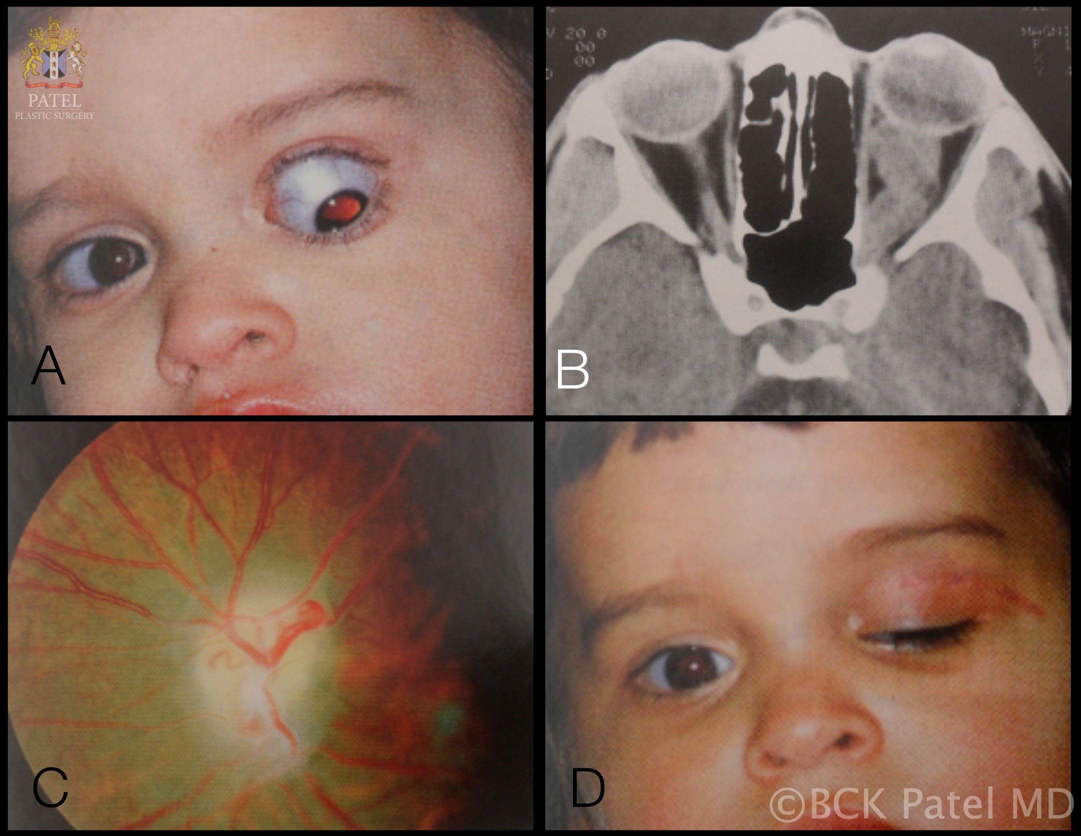 optic-nerve-glioma-article