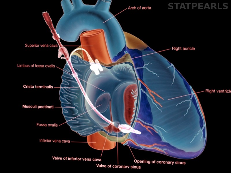 Anatomy Thorax Coronary Sinus Article StatPearls   13714