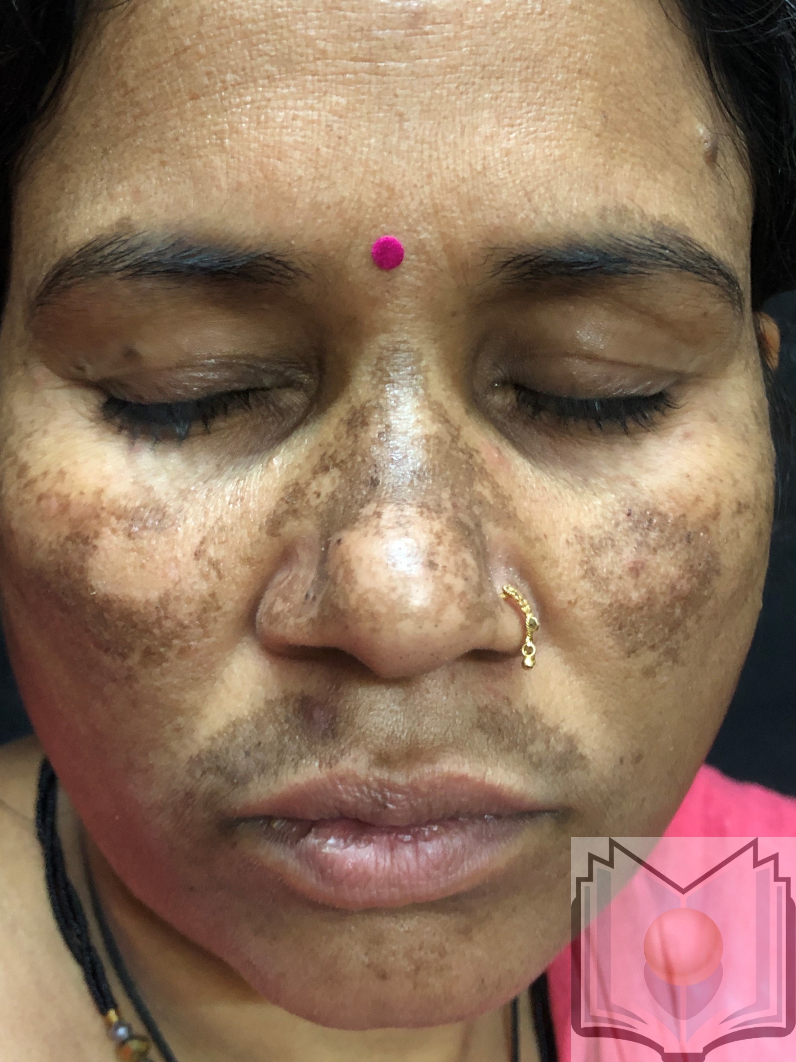 Melasma | Treatment & Management | Point of Care