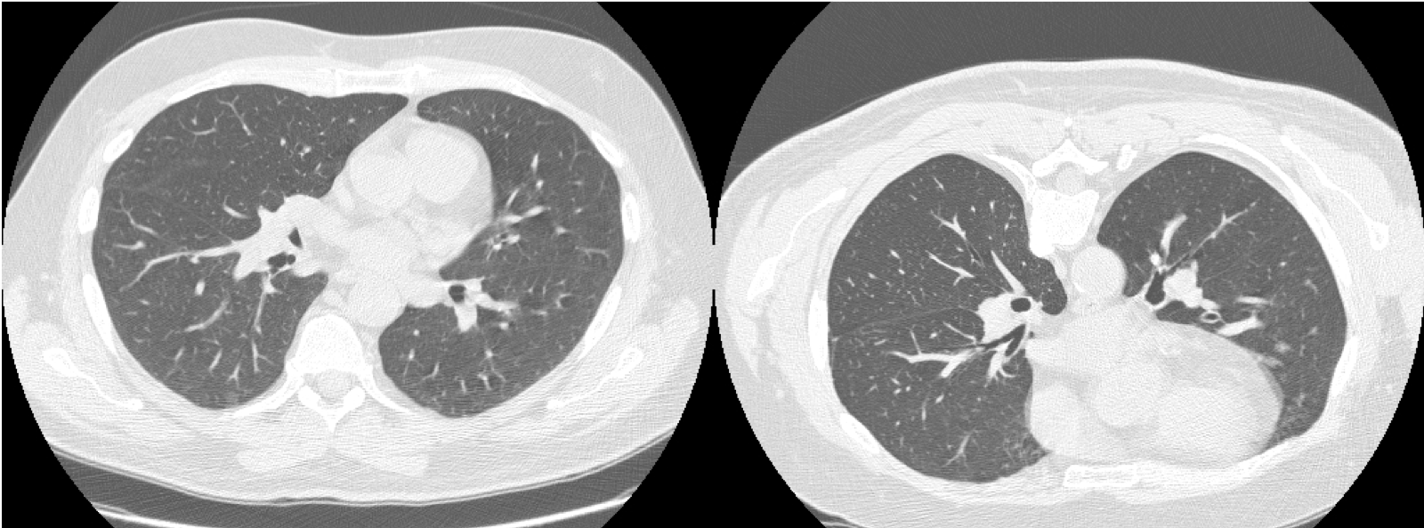 Lung Imaging Article