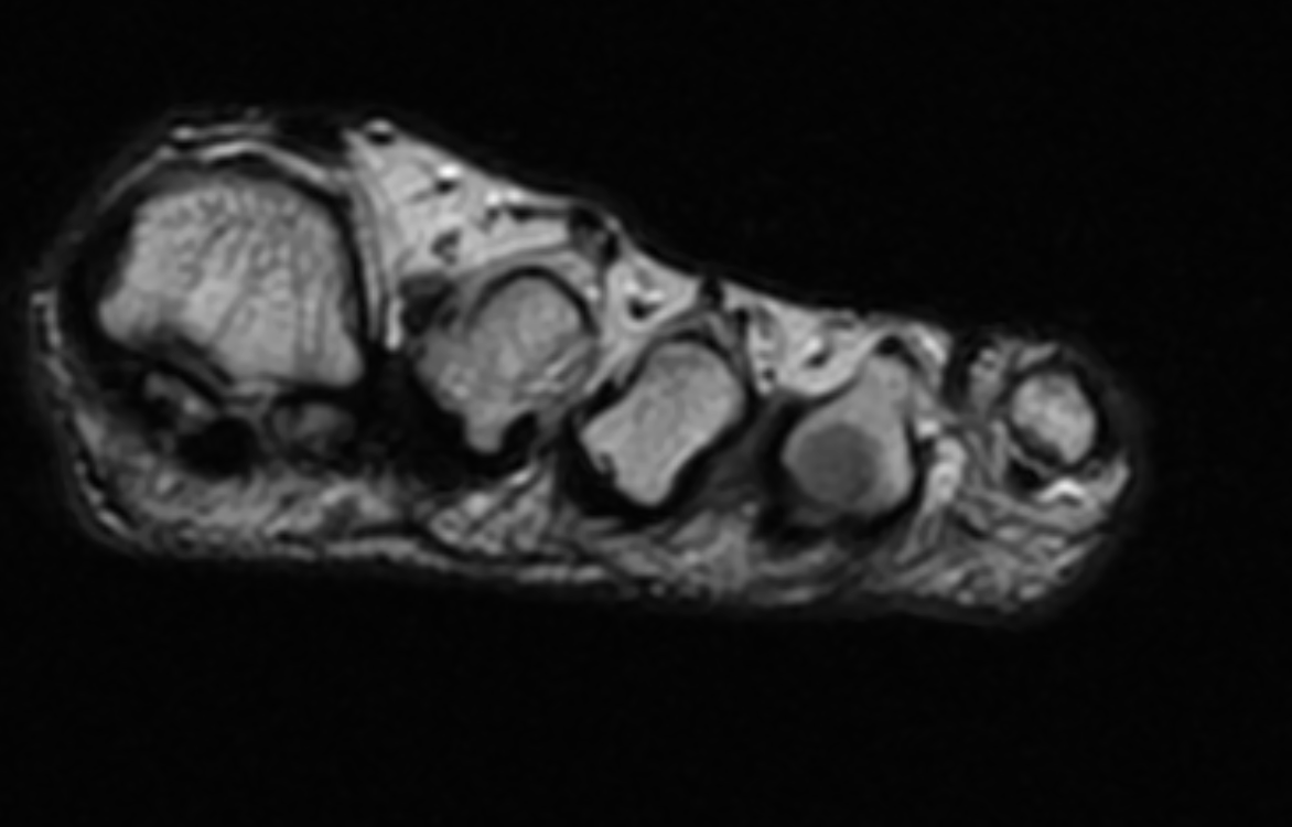 Morton Neuroma | Treatment & Management | Point of Care