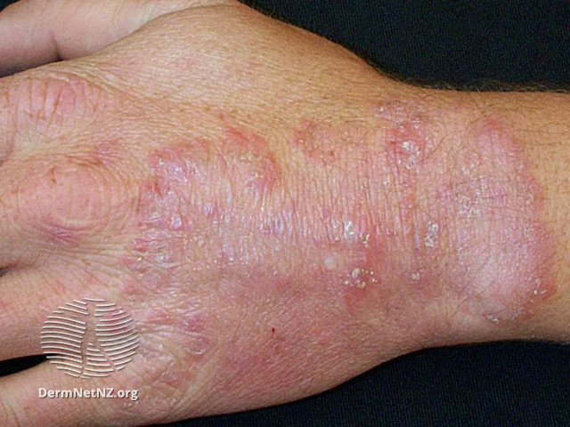 Tinea manuum: A report of 18 cases observed in the metropolitan