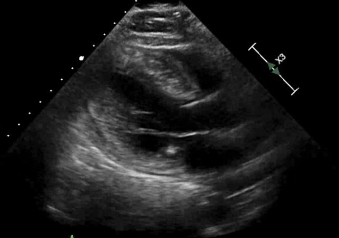 Hypertrophic Cardiomyopathy Article