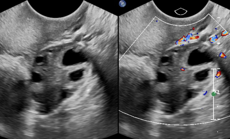 Pelvic Ultrasound Article