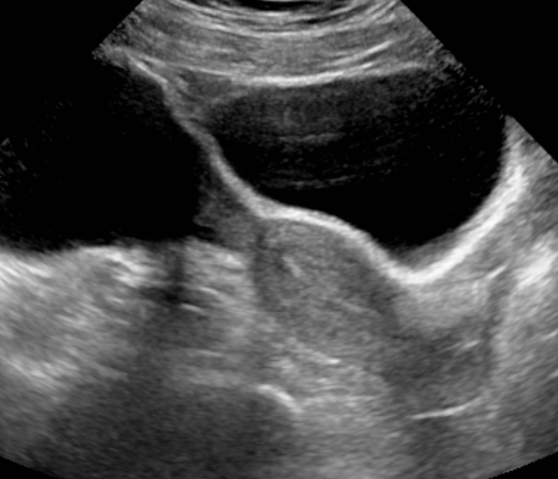 Pelvic Ultrasound Article