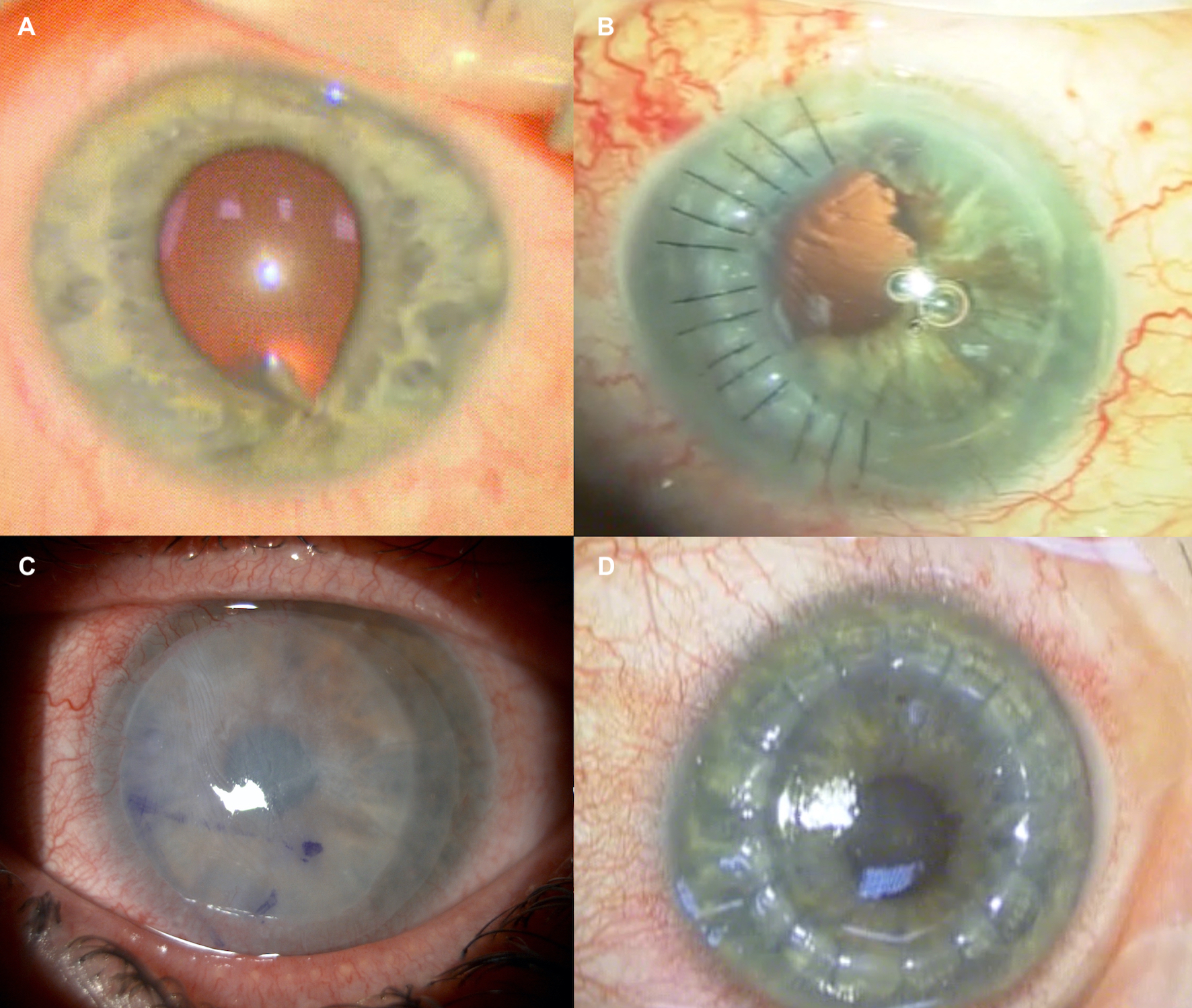 Corneal Laceration Vs Abrasion