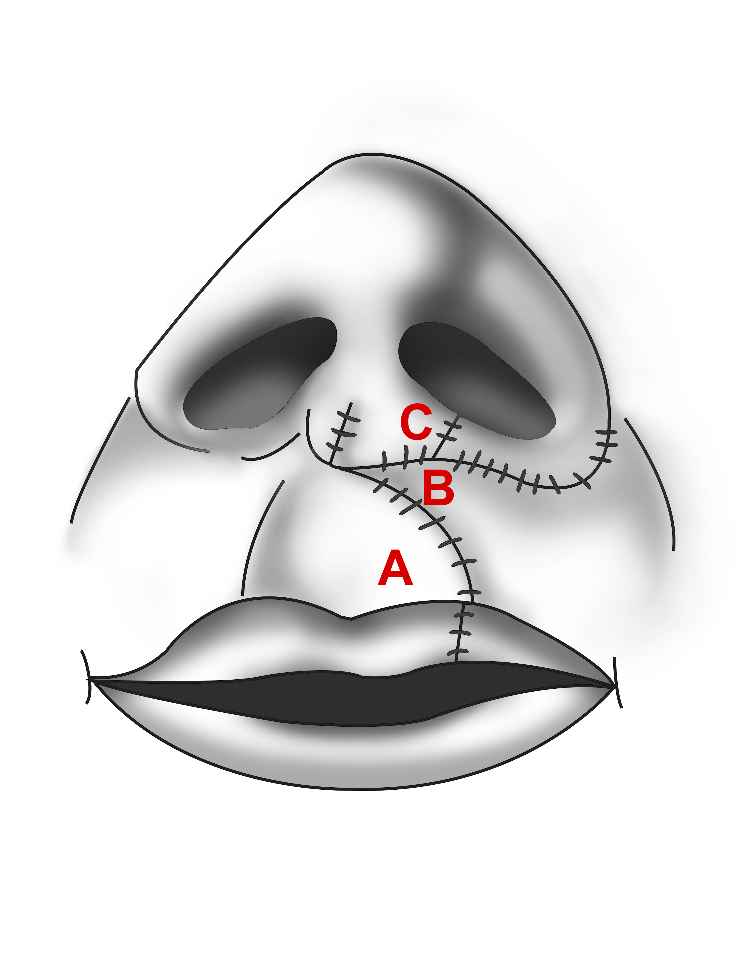 Cleft Lip Repair Article