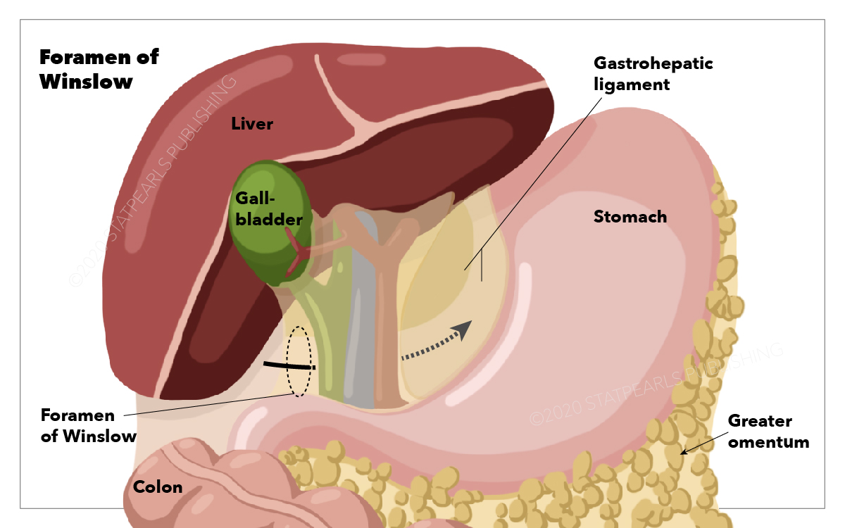 Anatomy, Abdomen and Pelvis, Foramen of Winslow (Omental, Epiploic) Article