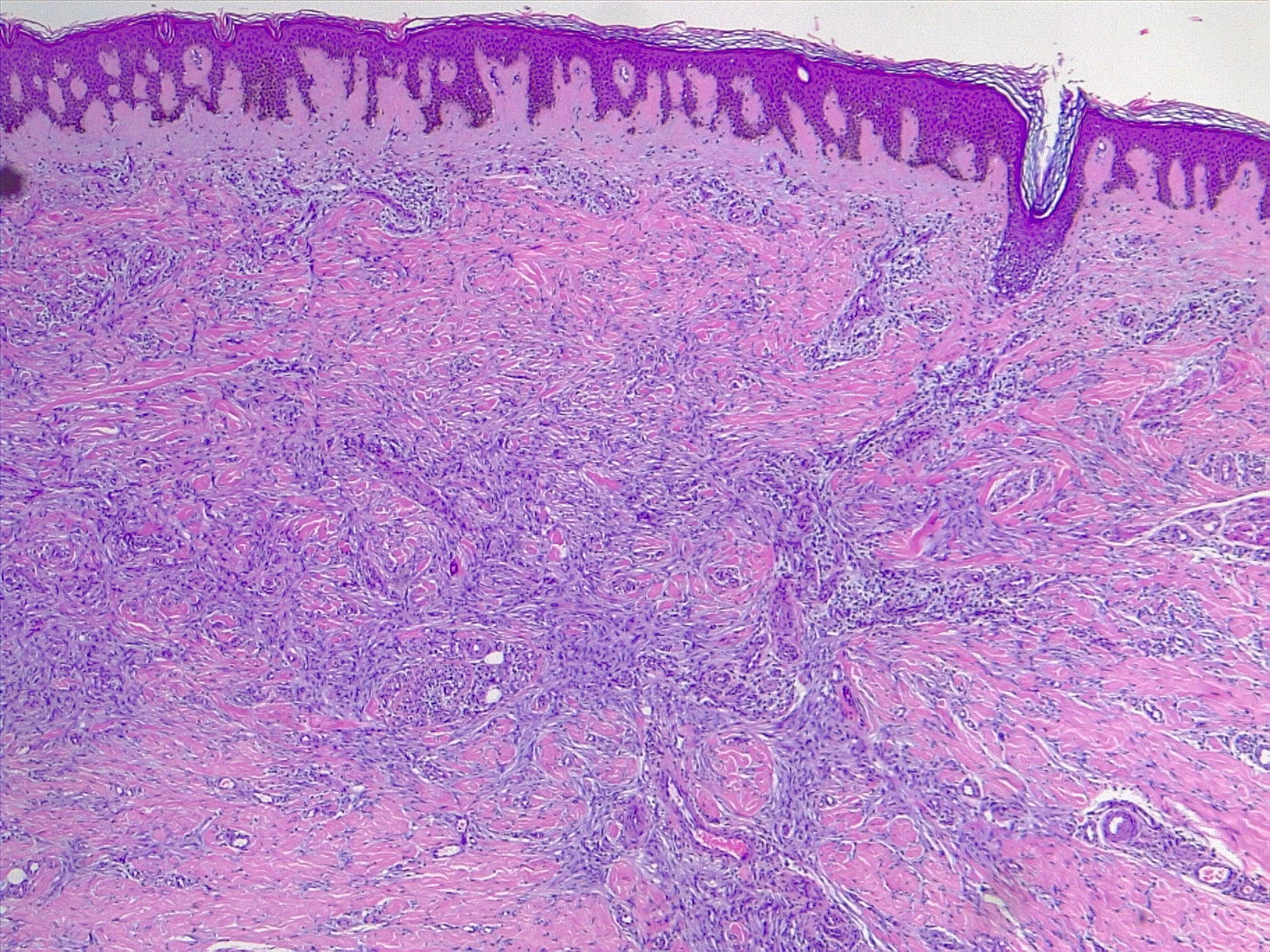 Dermatofibroma Histology