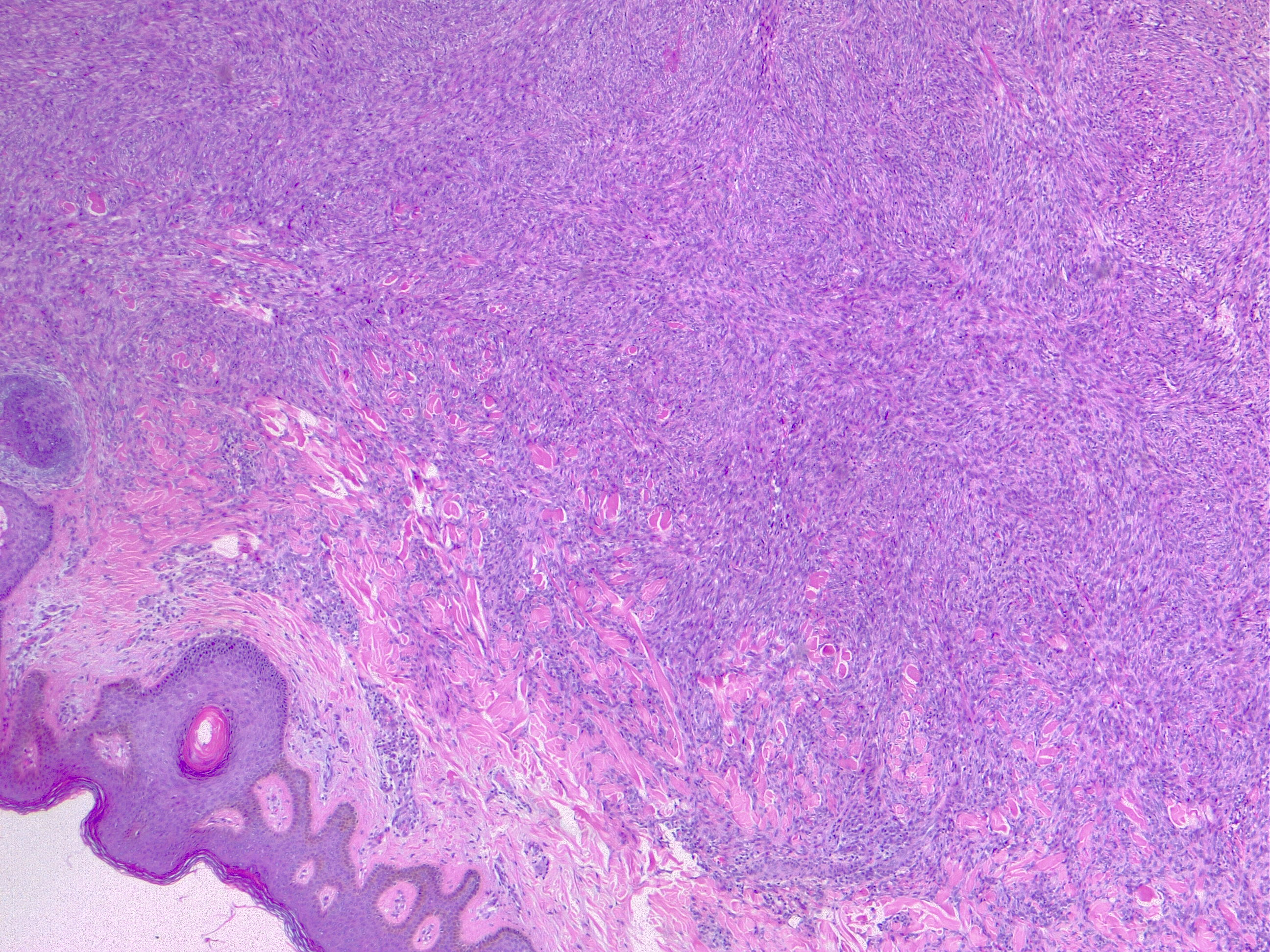 Dermatofibroma Histology