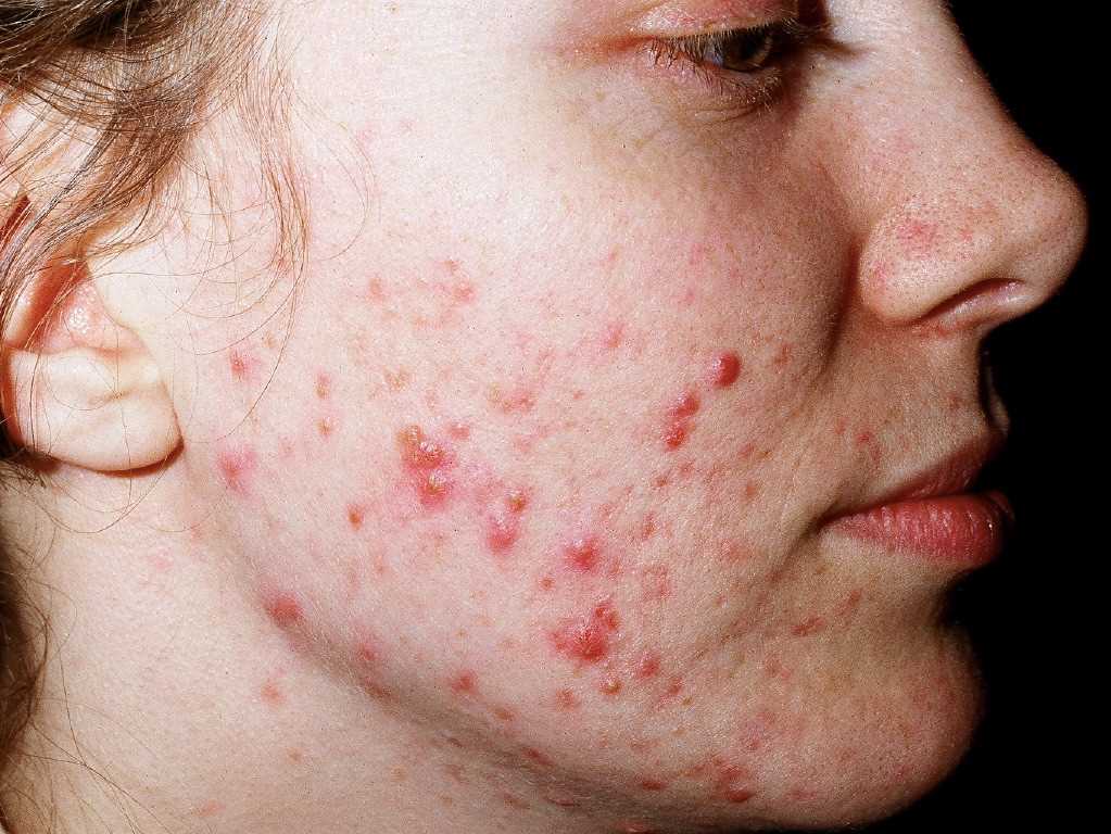 Acne Vulgaris Article