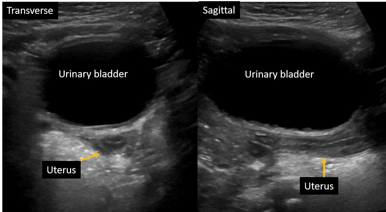 Sonography Pediatric Gynecology Assessment Protocols And