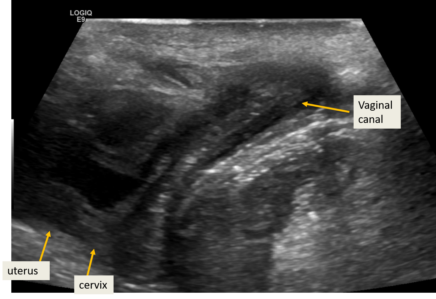 Sonography Pediatric Gynecology Assessment Protocols And Interpretation Article 