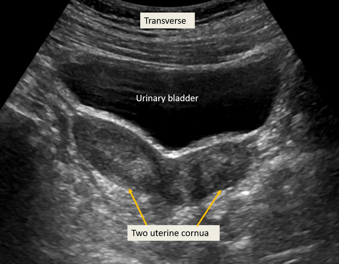 Sonography Pediatric Gynecology Assessment Protocols And Interpretation Article 