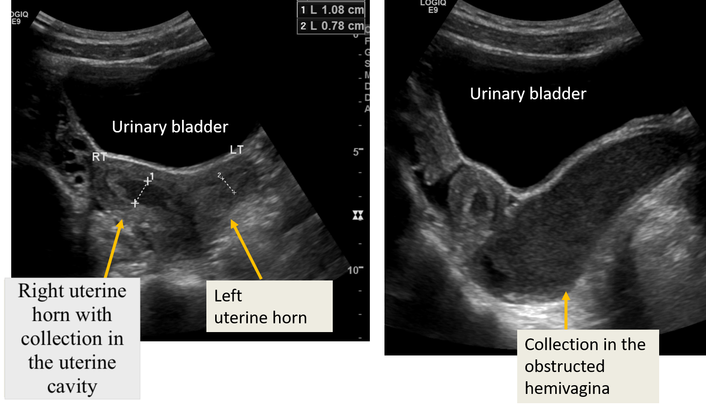 Sonography Pediatric Gynecology Assessment Protocols And