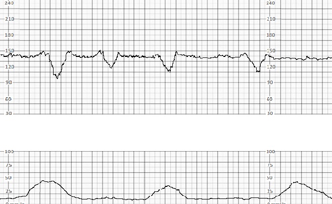 Fetal Monitoring Article