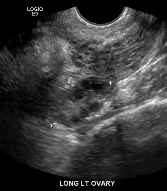 Sonography Transvaginal Assessment, Protocols, And Interpretation Article