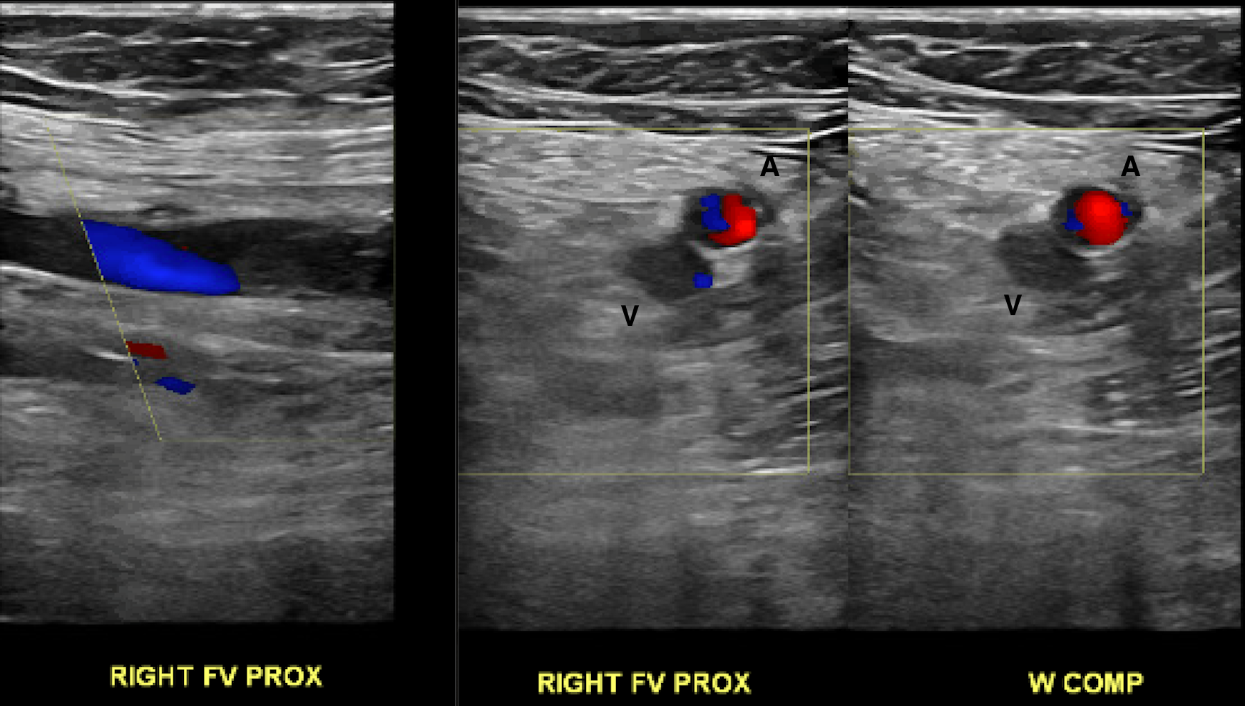 Sonography Vascular Peripheral Vein Assessment, Protocols, And ...