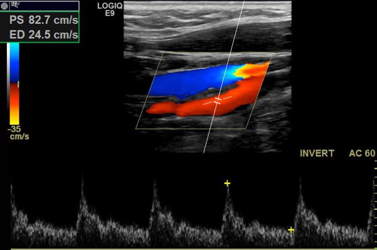 Doppler Extra-Cranial Carotid Assessment, Protocols, And Interpretation ...