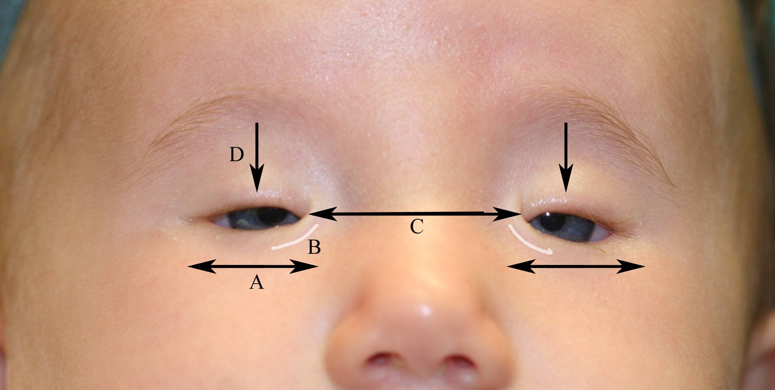 Congenital Ptosis Article