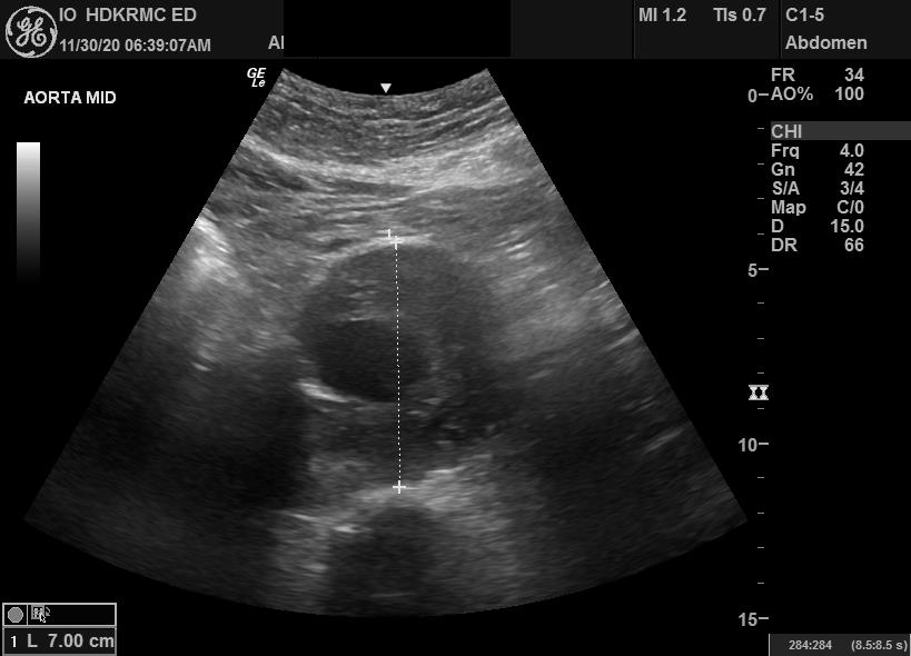 Sonography Abdominal Vascular Assessment, Protocols, And Interpretation ...