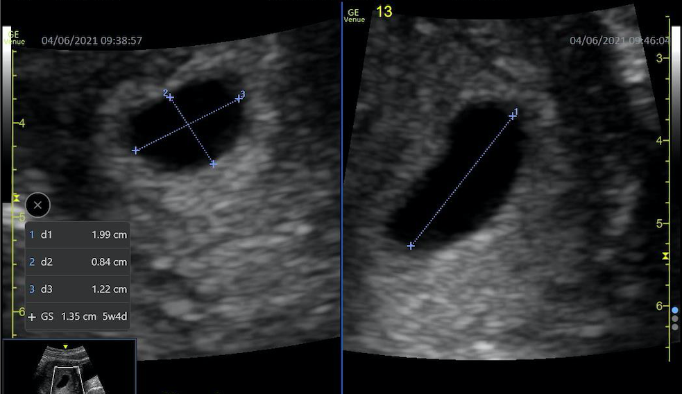 Sonography Assessment Of Gestational Age Article 1027