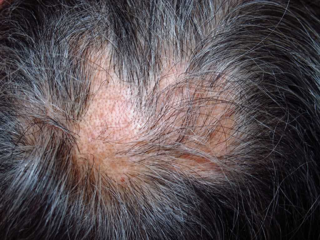 Alopecia Article