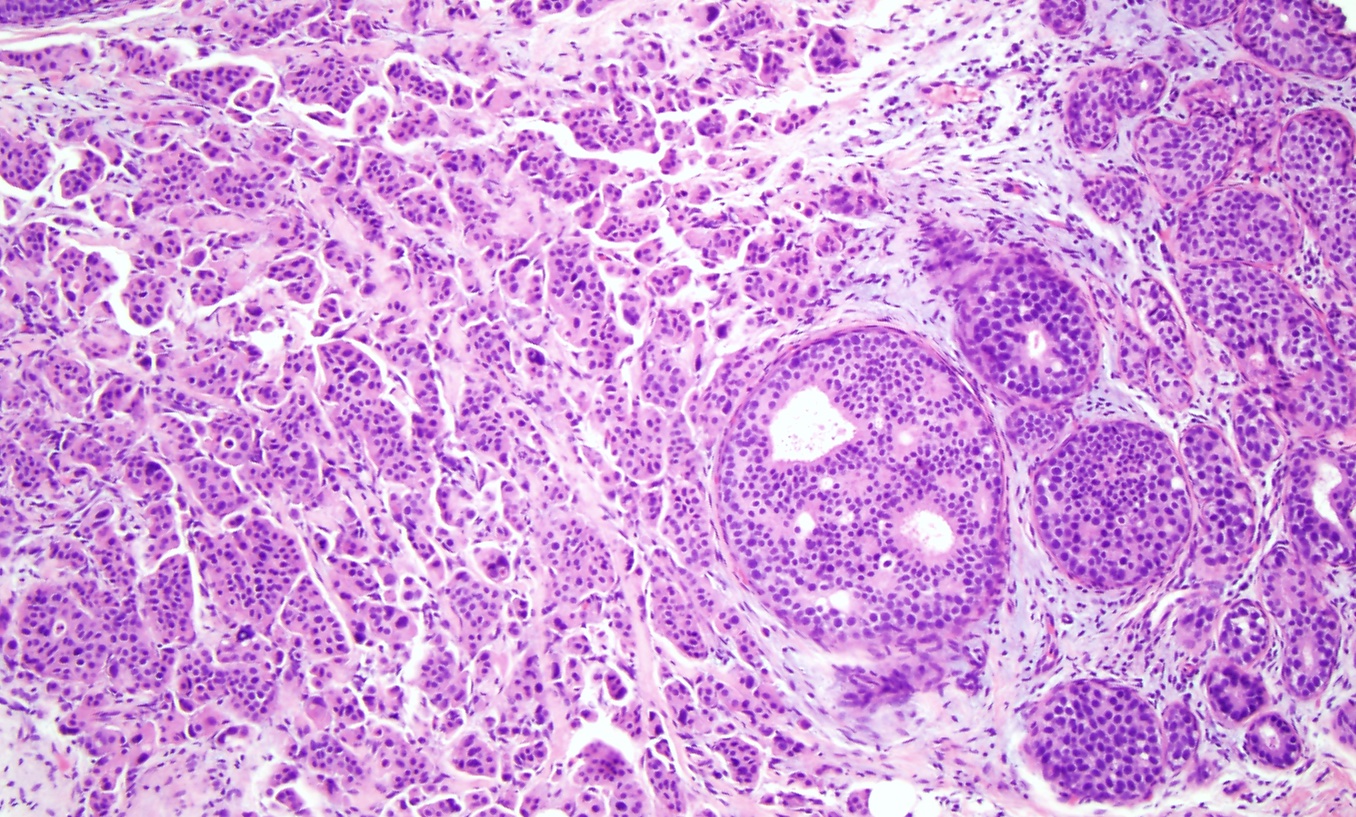 Breast Ductal Carcinoma in Situ Article