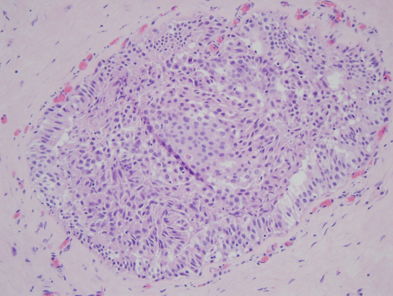 Atypical Ductal Hyperplasia | Treatment & Management | Point of Care