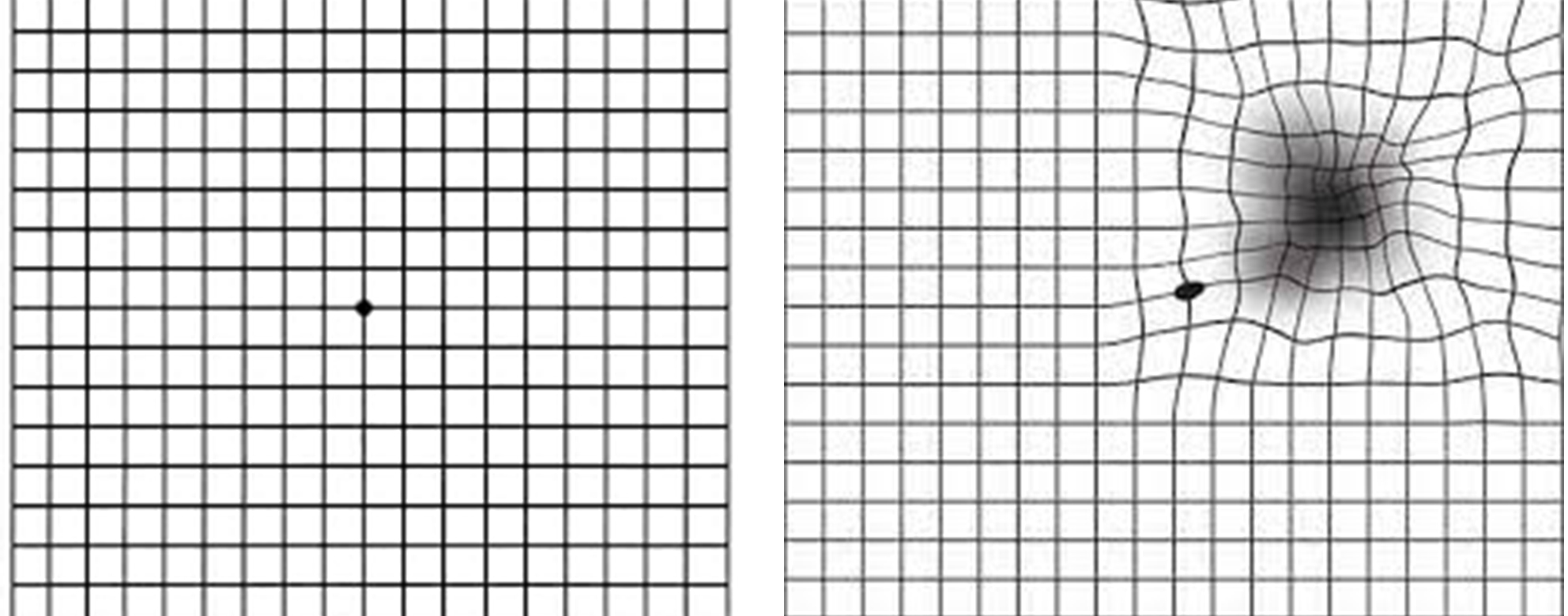 Wet Age-related Macular Degeneration (Wet AMD) Article