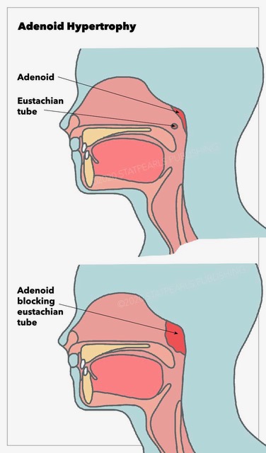 adenoid-hypertrophy-article