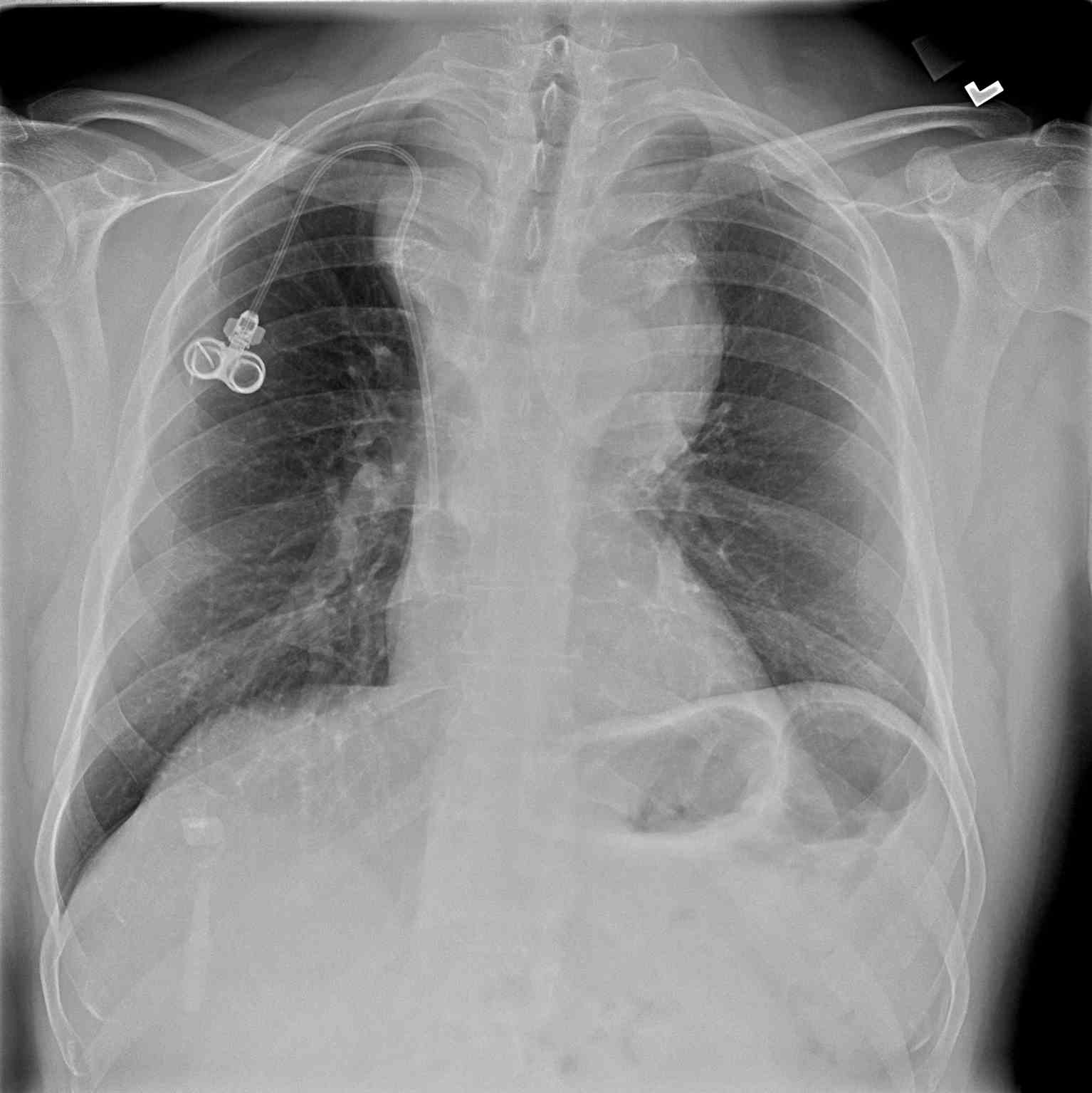 Anterior Mediastinal Mass | Treatment & Management | Point of Care