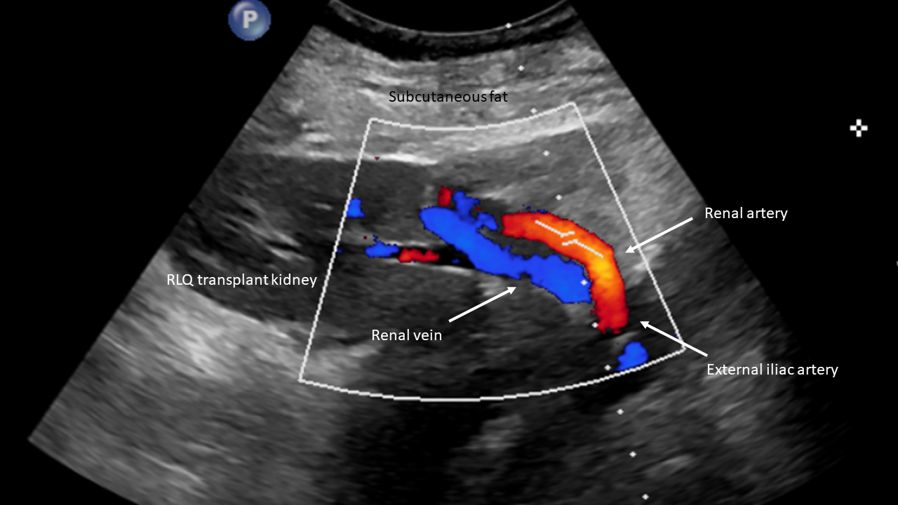 Renal Artery Anatomy Ultrasound