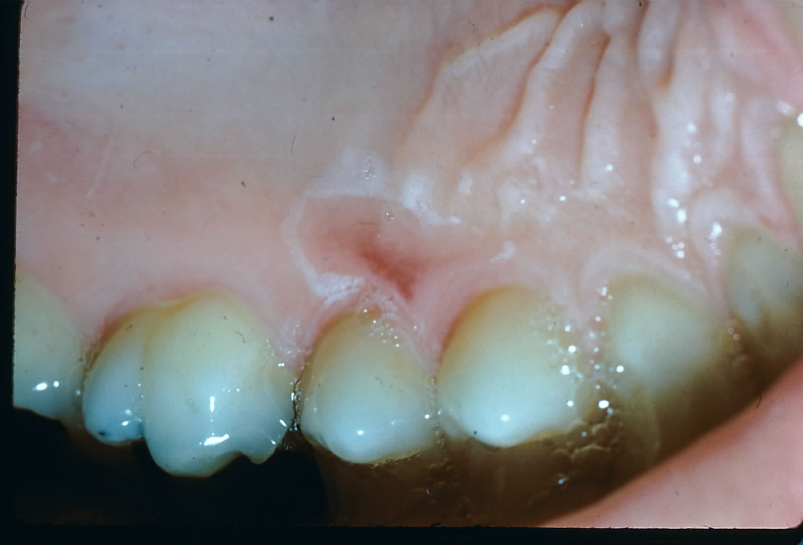 Physical And Chemical Lesions Of The Oral Mucosa Article