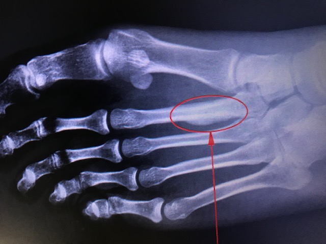 March Fracture (Metatarsal Stress Fractures) | Treatment & Management ...