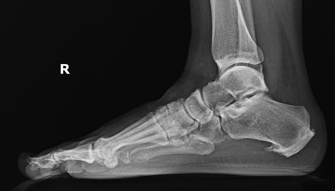 Plantar Fasciitis Article