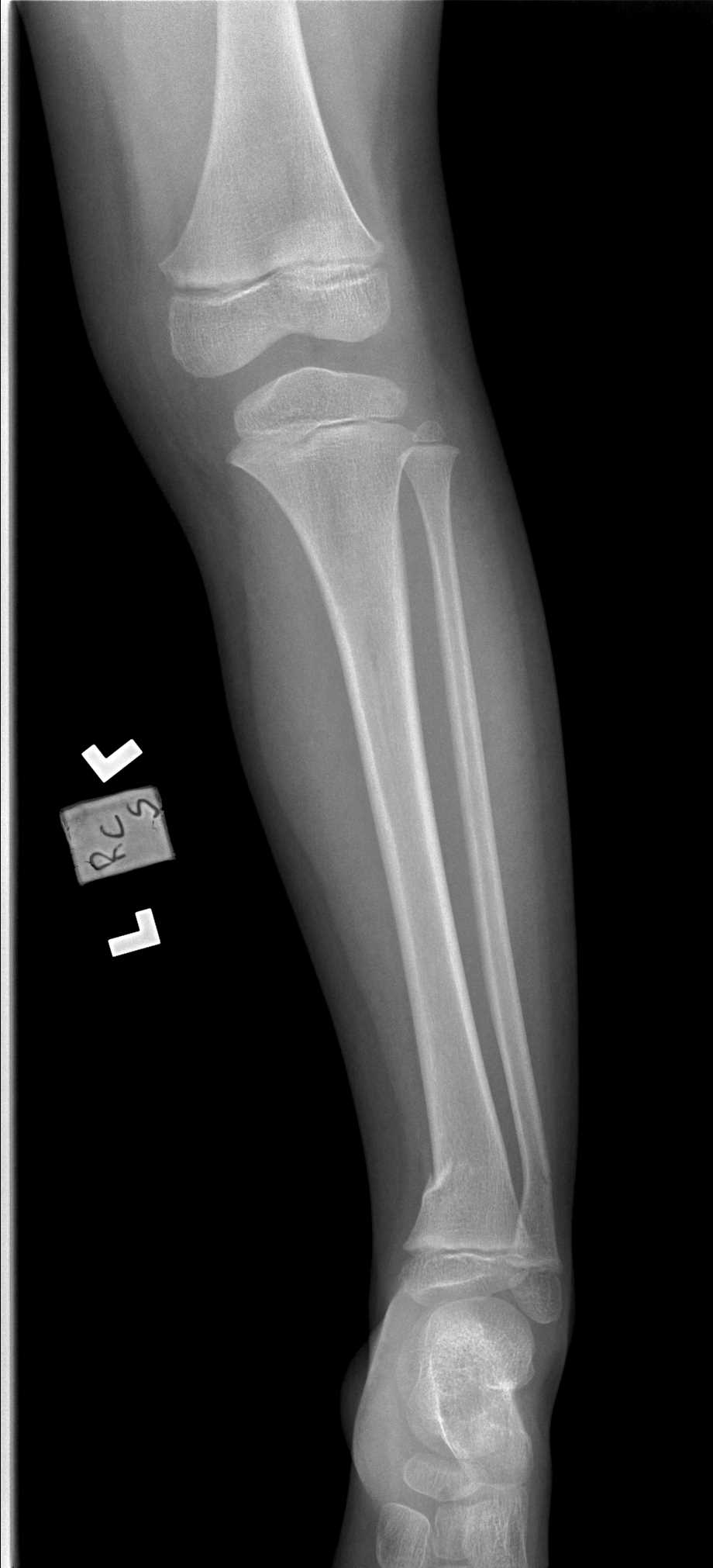 Greenstick Fracture Article