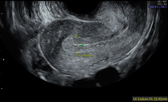 Sonography Gynecology Infertility Assessment, Protocols, and ...