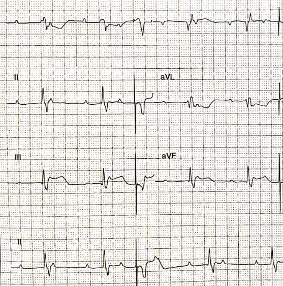 Pacemaker Malfunction Article