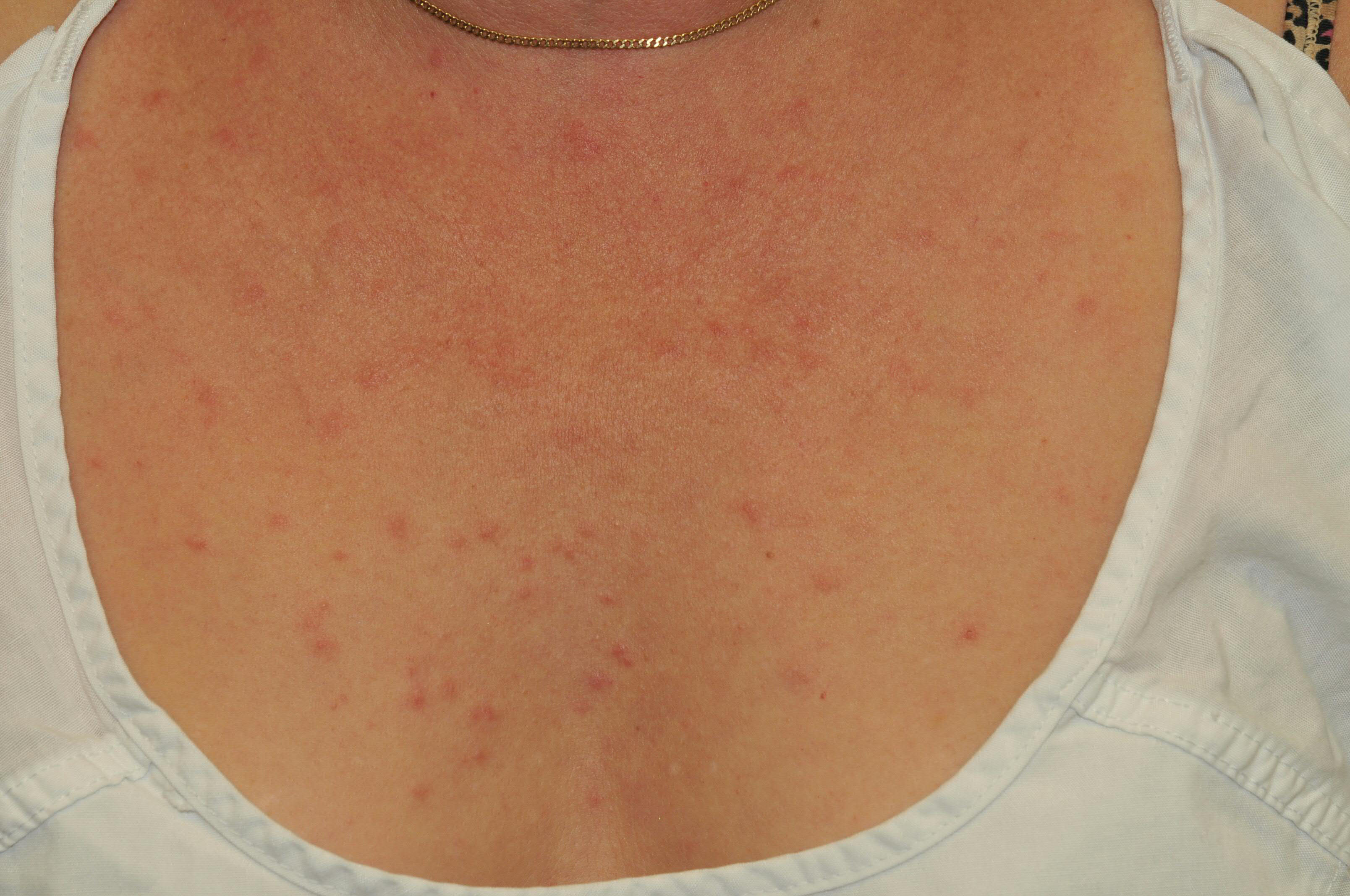 Tumid Lupus Erythematosus Article 