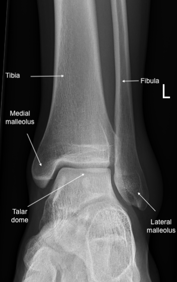 Ankle Fractures Article